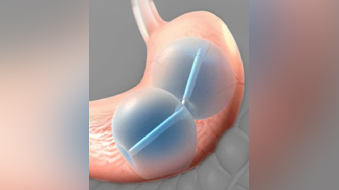 FDA approves stomach-filling balloon for weight loss