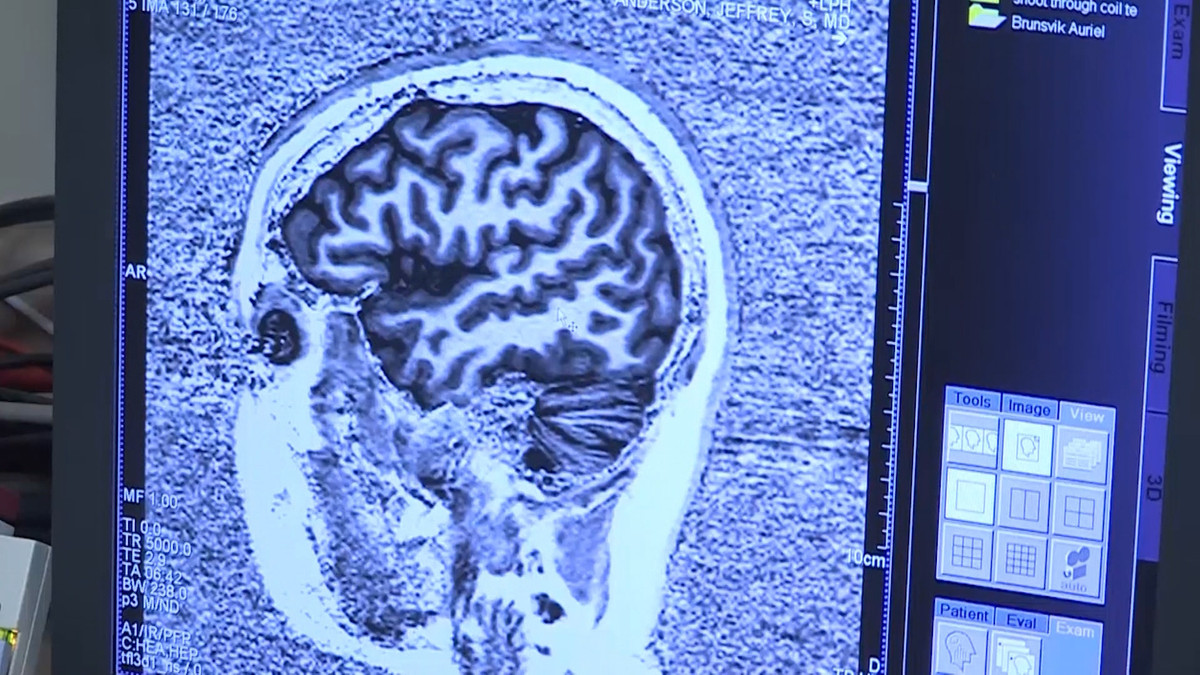 Alzheimer's disease will strain future Medicaid budgets, report says