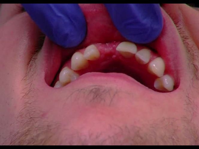 Adolescentes implementan práctica que hacen peligrar sus dientes