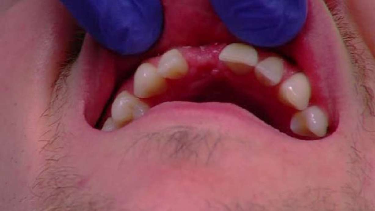 Adolescentes implementan práctica que hacen peligrar sus dientes