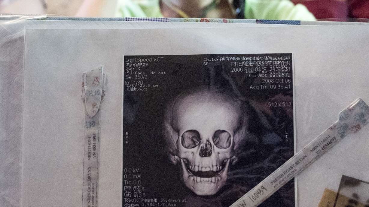 Elkhorn family adopts children with facial differences