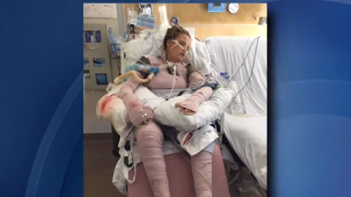 Niña de UT tiene el 65% de su cuerpo quemado; su familia cuanta sus bendiciones