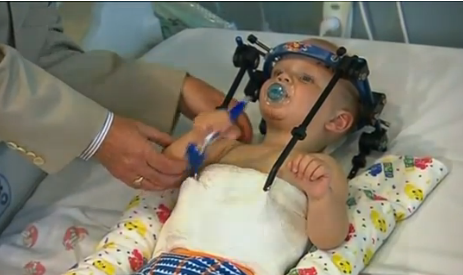 Médico une la cabeza a la columna de un niño de 11 meses en cirugía milagrosa tras accidente