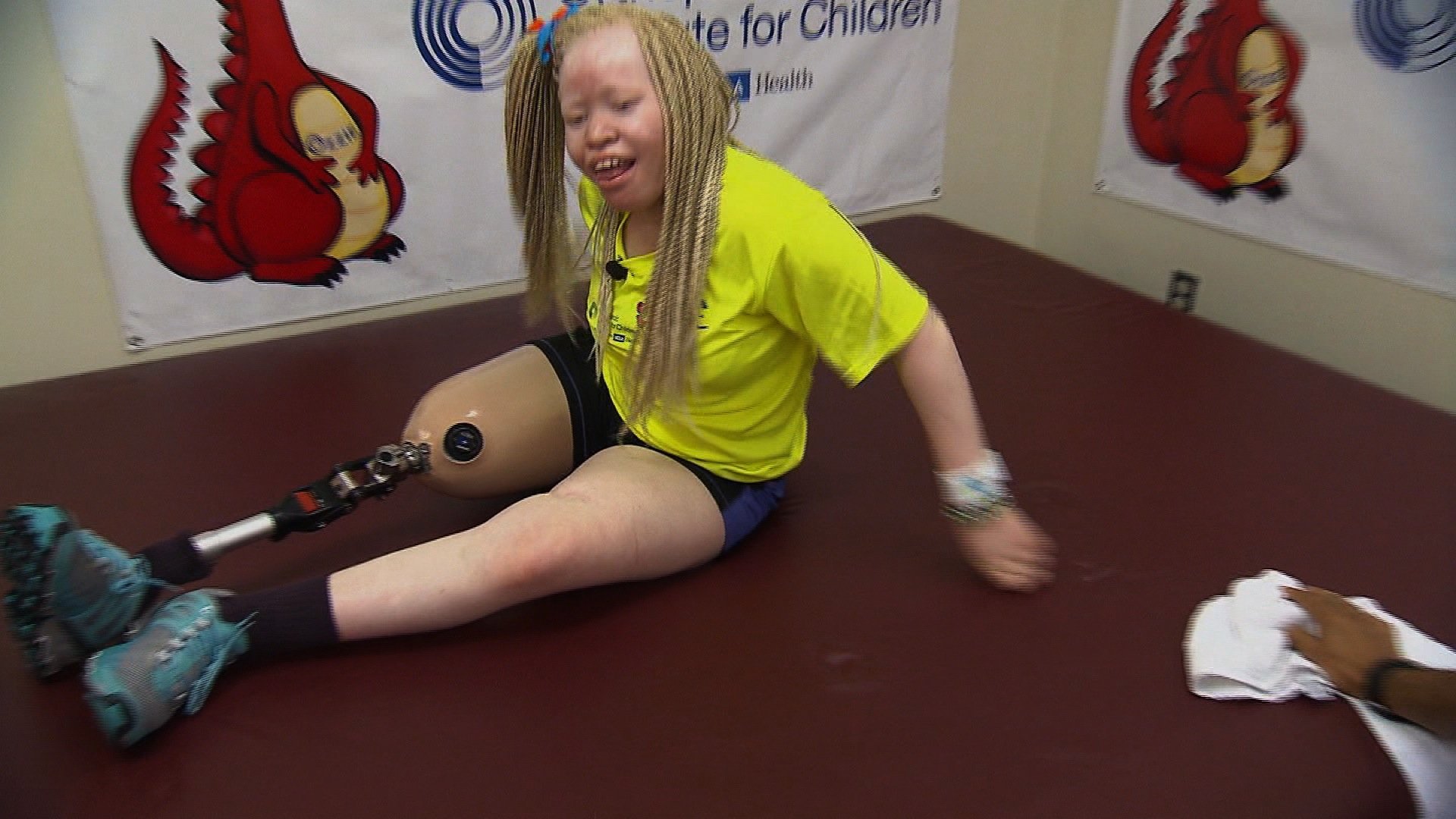 Bibiana Mashamba was attacked 6 years ago near the city of Mwanza in her home country of Tanzania. The robbers wanted something much more precious than jewels or electronics. They wanted the bones of the teen born with albinism. (Photo: CNN)