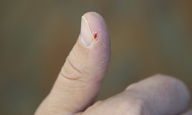 Split Oper Finger Why Do My Fingers Split In Winter | Gas Furnace