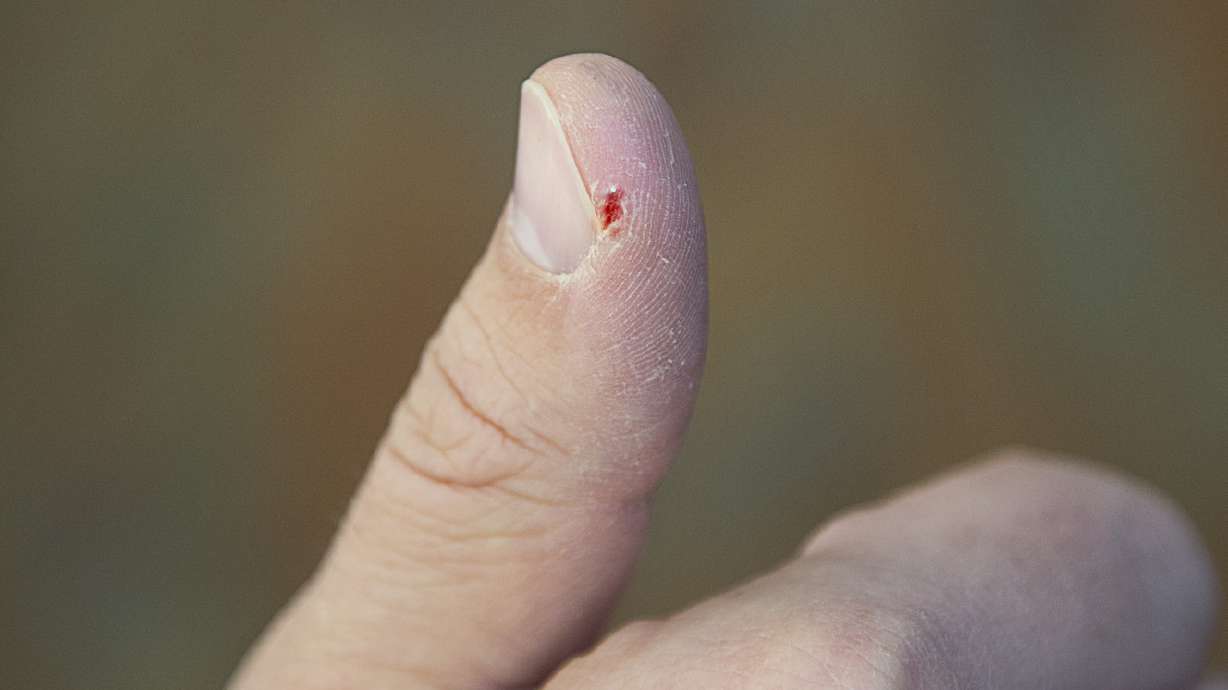 Dermatologist tips for treating dry, cracked hands