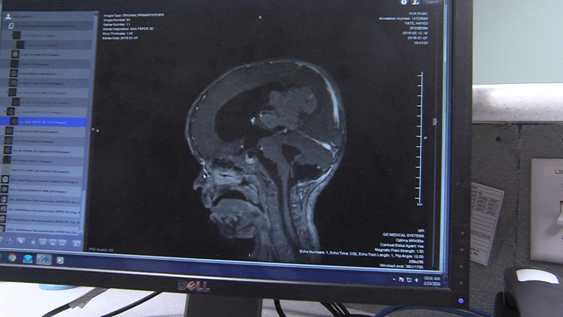 CT Scan of Hayes Tate's brain tumor (Photo: Brandon Whitworth)