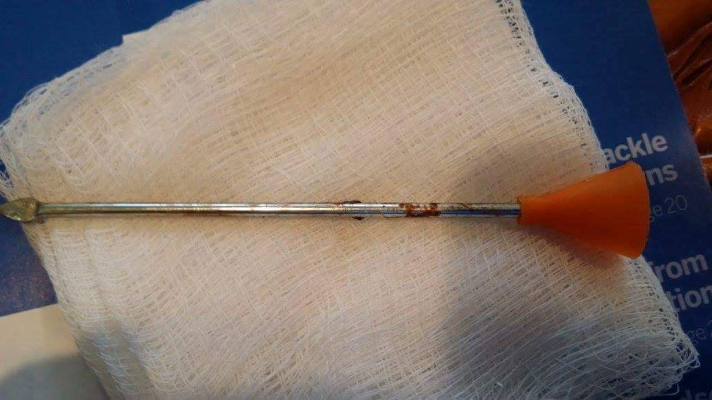 The blow dart was removed during surgery. (Photo: Courtesy Dr. Isaac Bott)