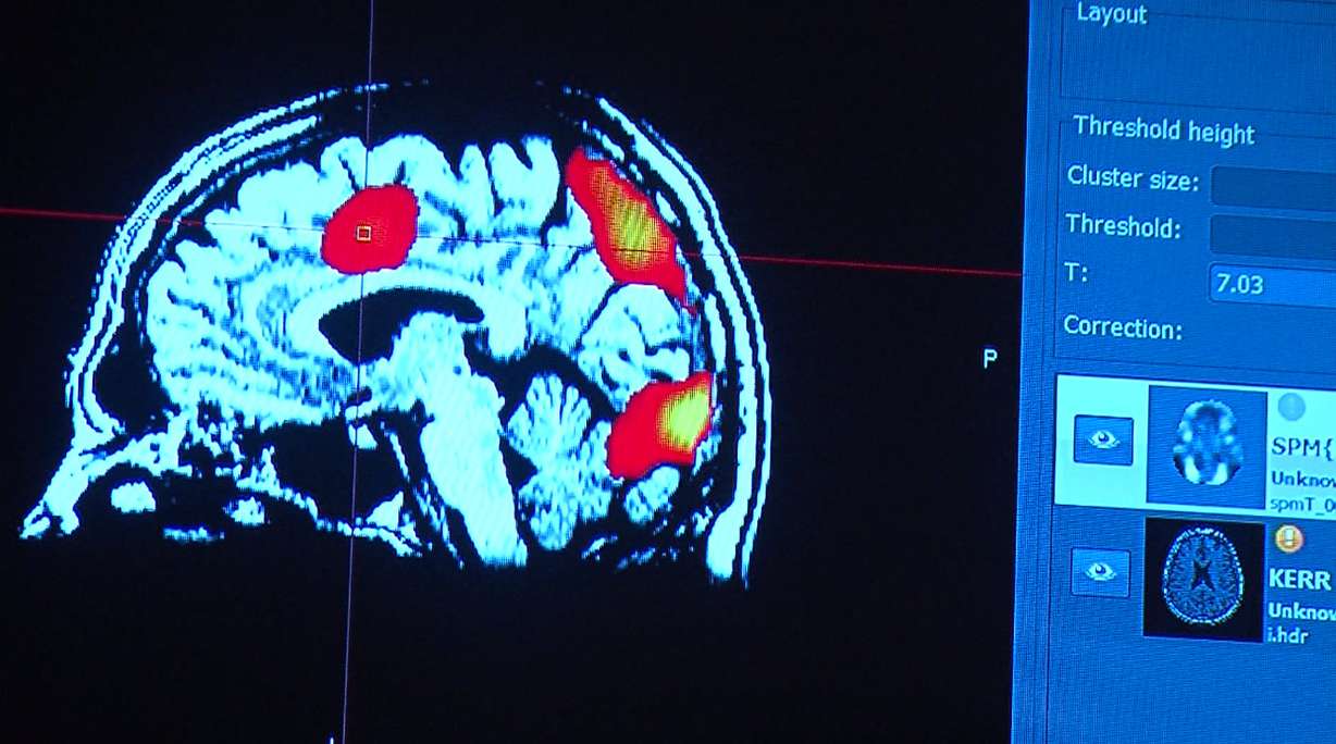 Cognitive FX in Provo has developed new methods of using functional MRIs to target therapy on specific damaged regions of the brain. (Photo: Ken Fall, KSL-TV)