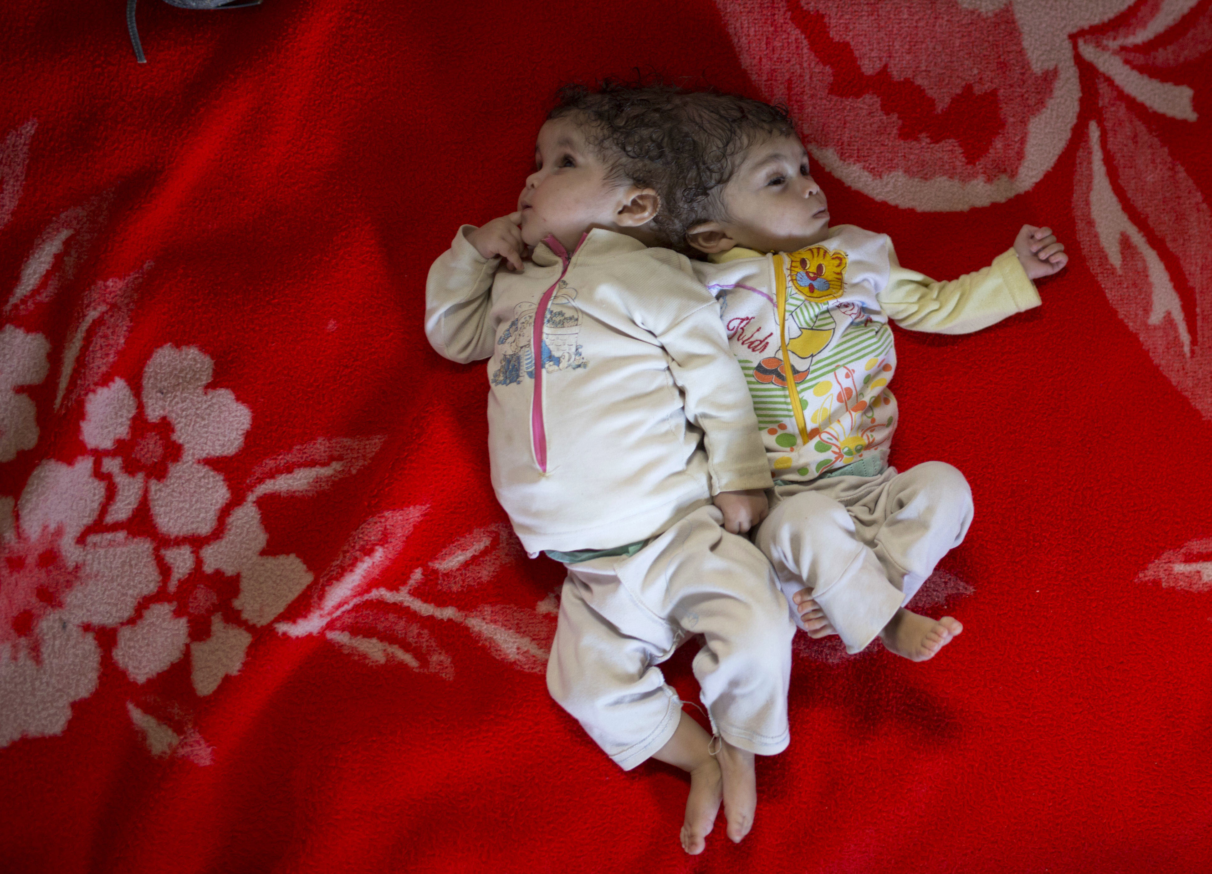 Egyptian family seeks help for conjoined twins