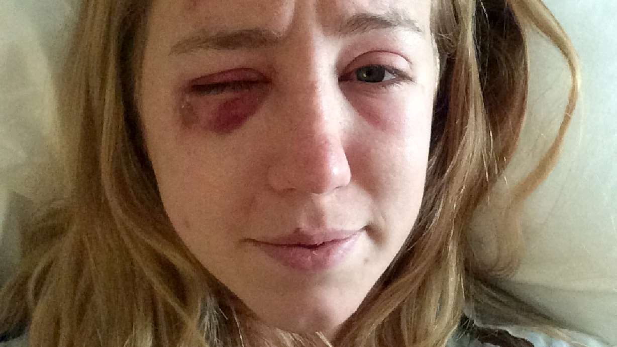 Woman who survived lightning strike feels lucky to be alive