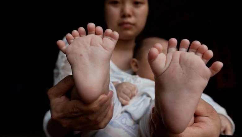 Chinese boy born with 31 fingers and toes; parents hope for surgery