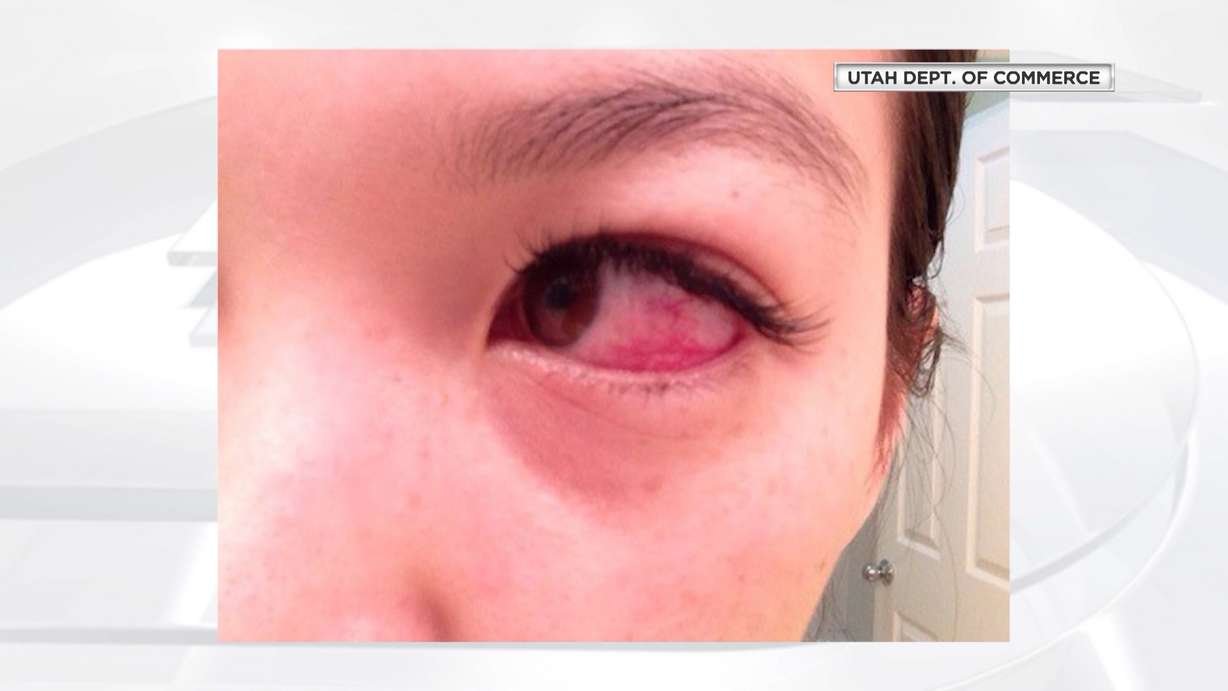 Undated photo of an eye infection resulting from application of eyelash extension by an unlicensed provider. The Utah Division of Occupational and Professional Licensing is warning the public about possible health risks associated with using unlicensed providers for eyelash and eyebrow extensions that require lash-by-lash application. (Photo: Utah Department of Commerce)