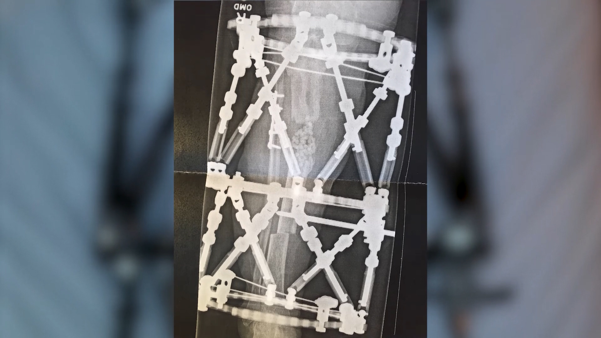 X-ray of Nina Jacobs' leg after an operation. (Family photo)