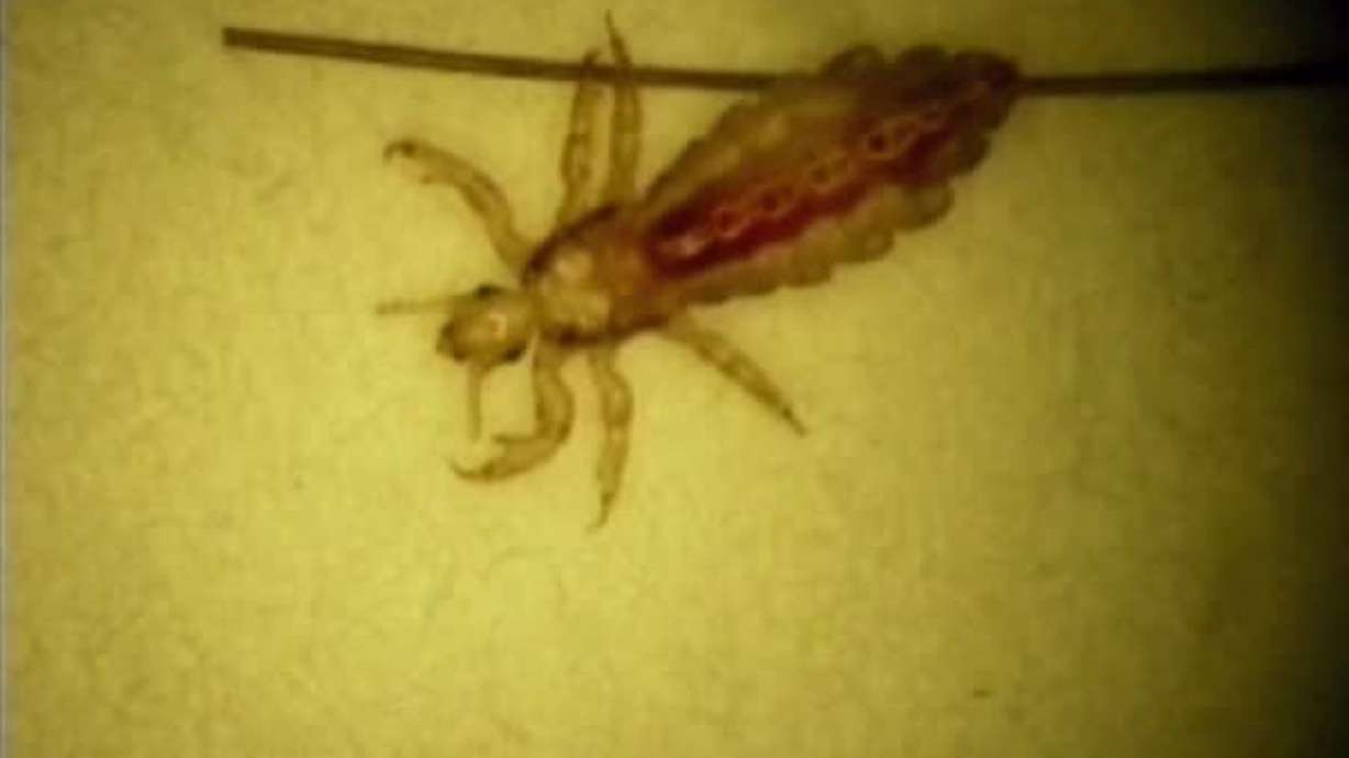 Tips for getting rid of ‘super lice’