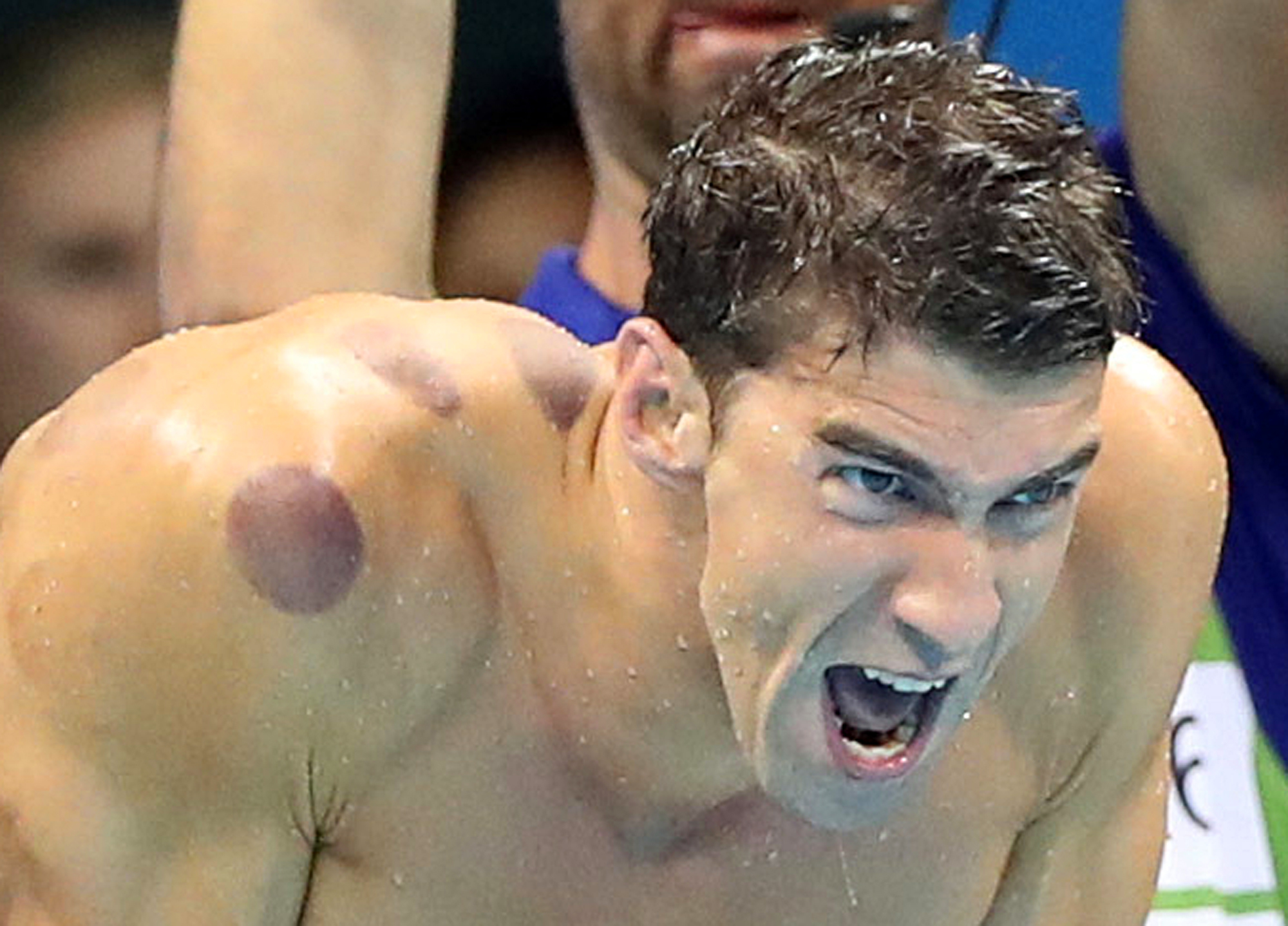 Phelps is touting the benefit of cupping _ but does it work?