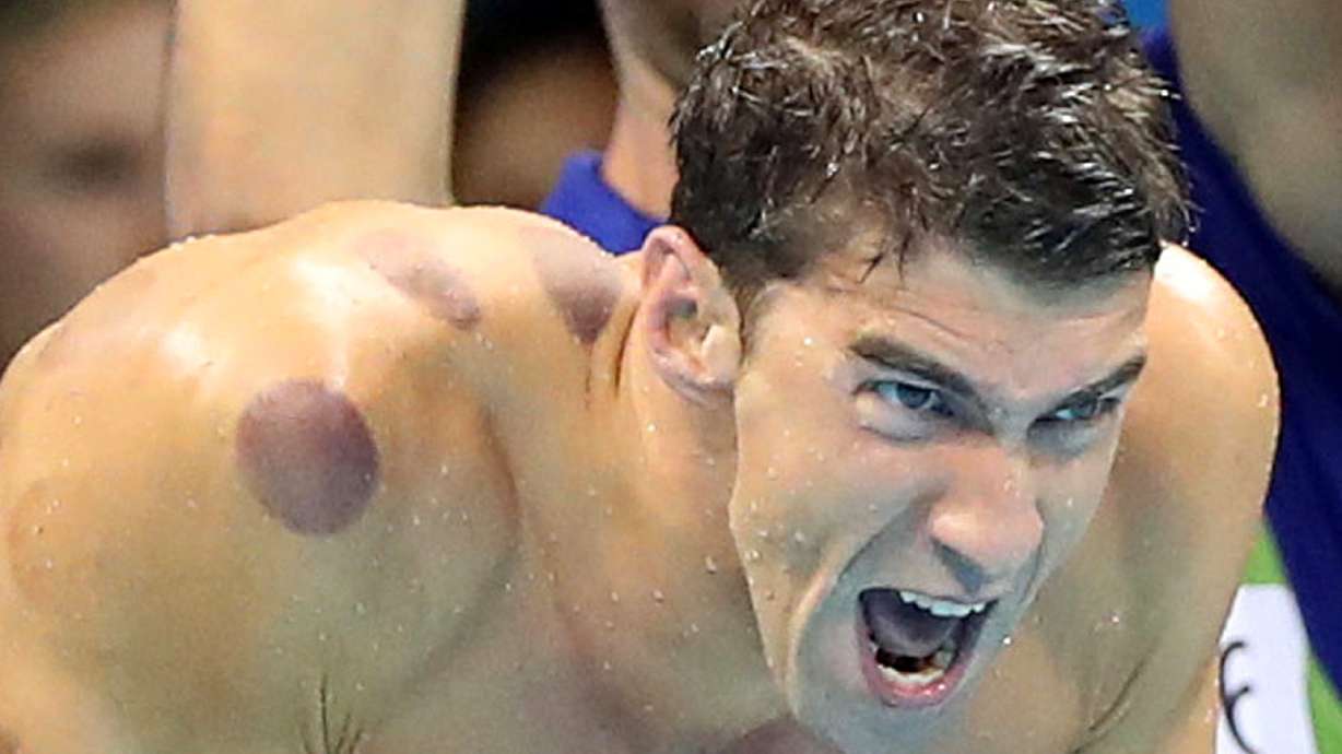 Phelps is touting the benefit of cupping _ but does it work?