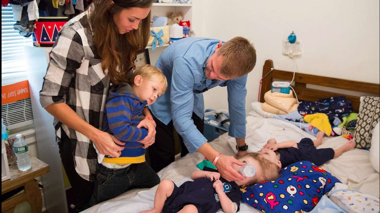 Separated twins: After hardest surgery, the quickest recovery