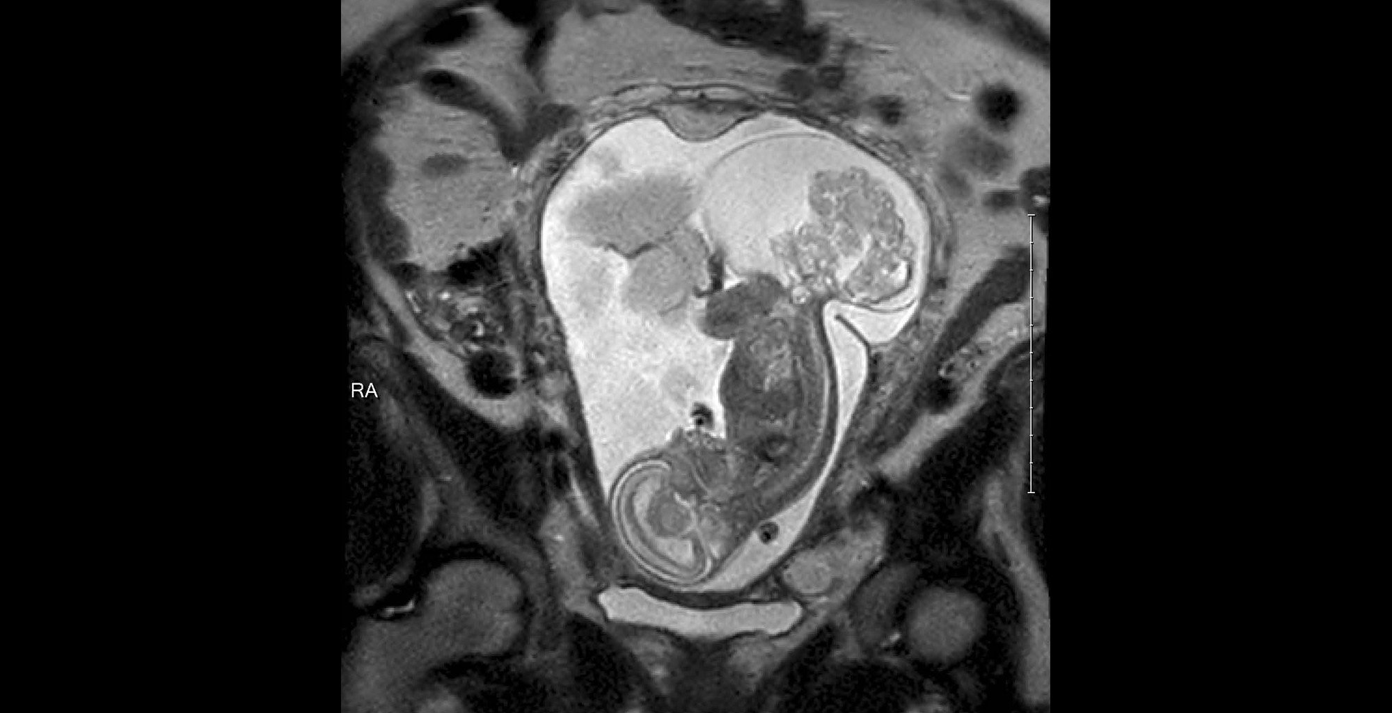 The tumor threatening LynLee's life can be seen in this ultrasound. Sacrococcygeal teratoma is found more often in girls than boys. (Photo: Courtesy Paul Vincent Kuntz)