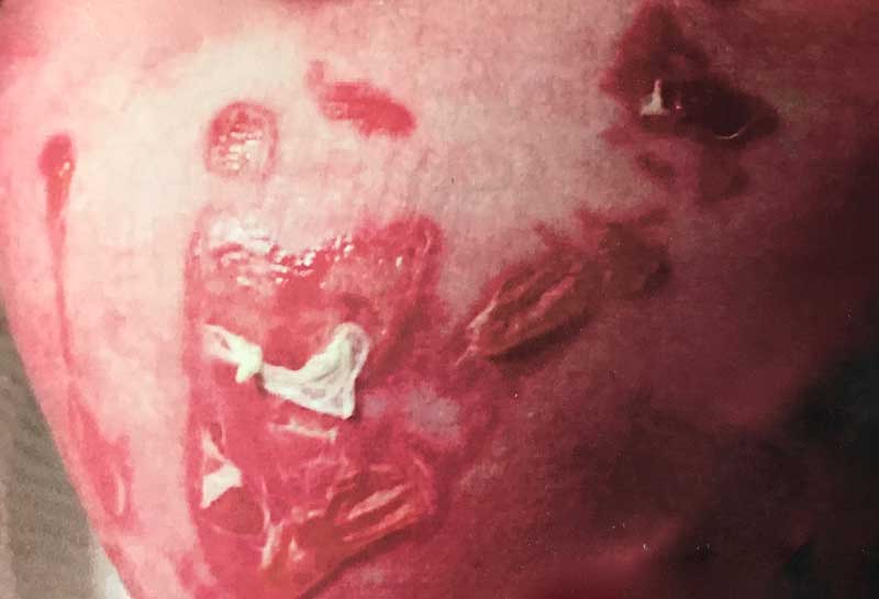 A photo of the burns inflicted on newborn baby Londyn Porter during her first few hours of life. (Photo: Court Record)