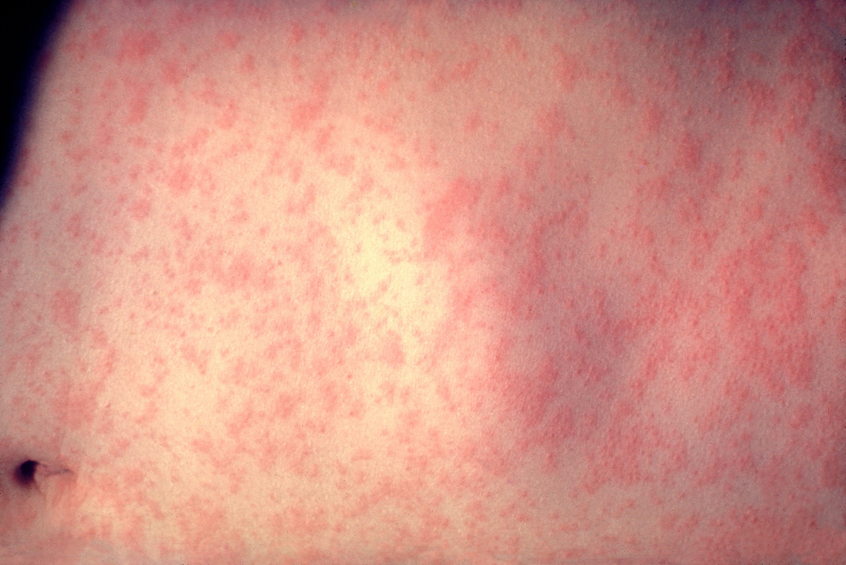 Measles infections hit decade high in Europe