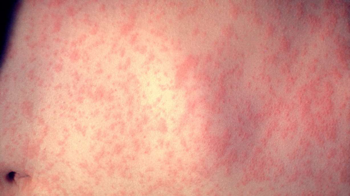 Measles accelerates to second-highest level in US in 25 years and over 100,000 global cases