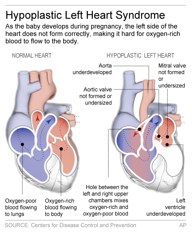 Testing stem cells in tiniest hearts to fight birth defect