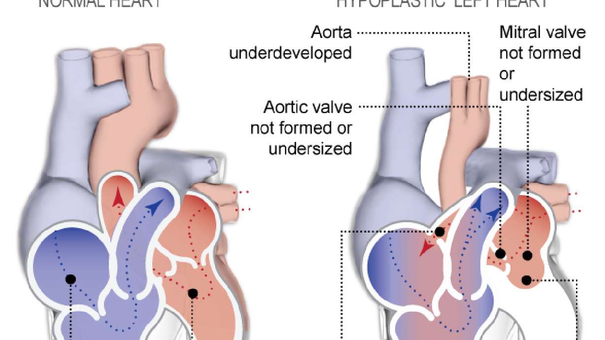 Testing stem cells in tiniest hearts to fight birth defect
