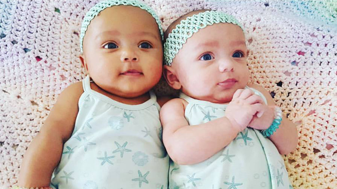 Twin baby girls have different skin colors