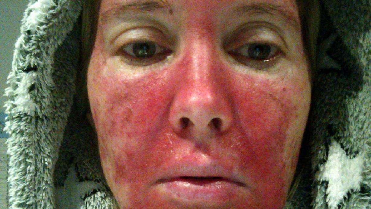 'Now I'm paying the price': Woman's gruesome pictures expose dangers of tanning