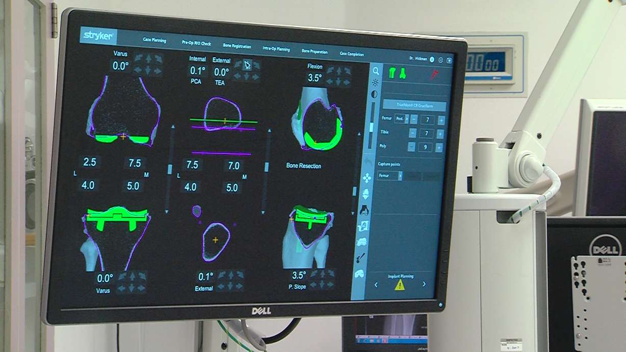 A computer screens shows details of robotic knee-replacement surgery at Lakeview Hospital in Bountiful. (Photo: KSL TV)