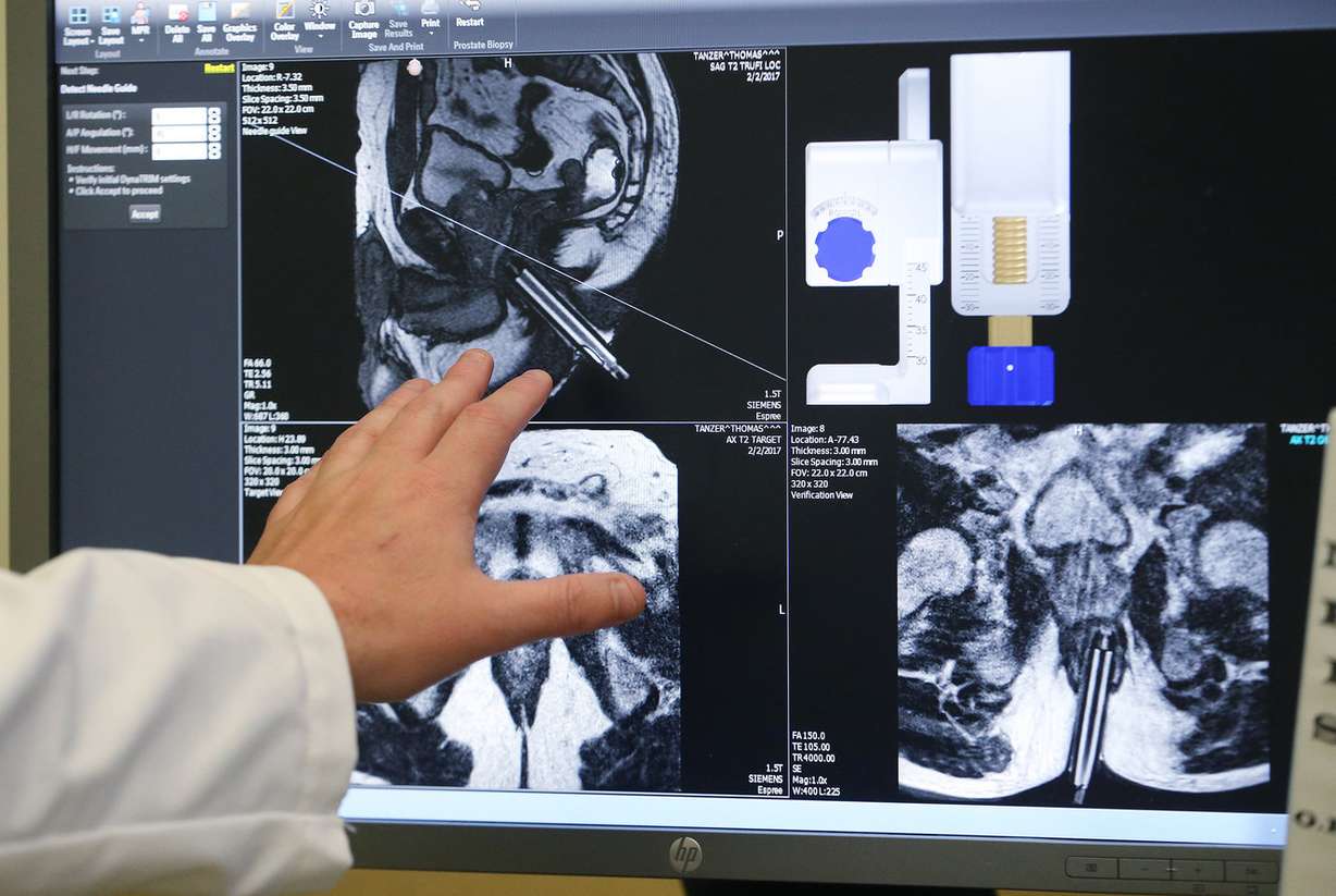 MRI views of a cancer patient are seen at the Huntsman Cancer Institute in Salt Lake City on Friday, April 14, 2017. The institute acquired new technology a year ago to conduct MRI-guided prostate biopsies. With this technology, a radiologist can conduct the biopsy in the MRI suite and use the MRI to move the needle to a targeted, specific spot of interest. (Photo: Jeffrey D. Allred, Deseret News)