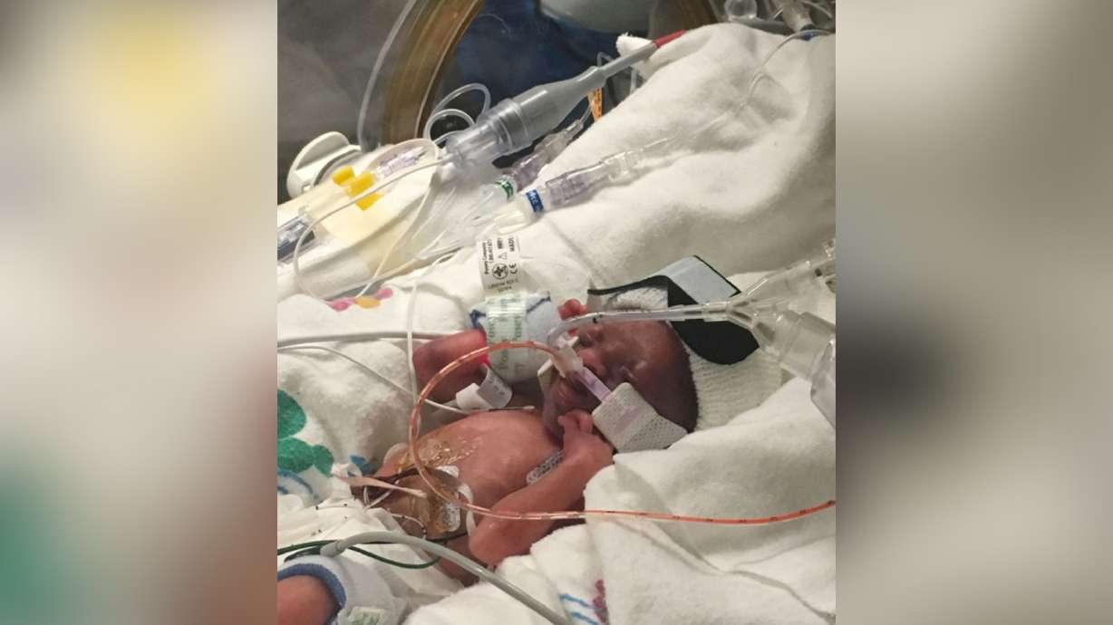 Premature 1-lb. baby recovers from heart surgery