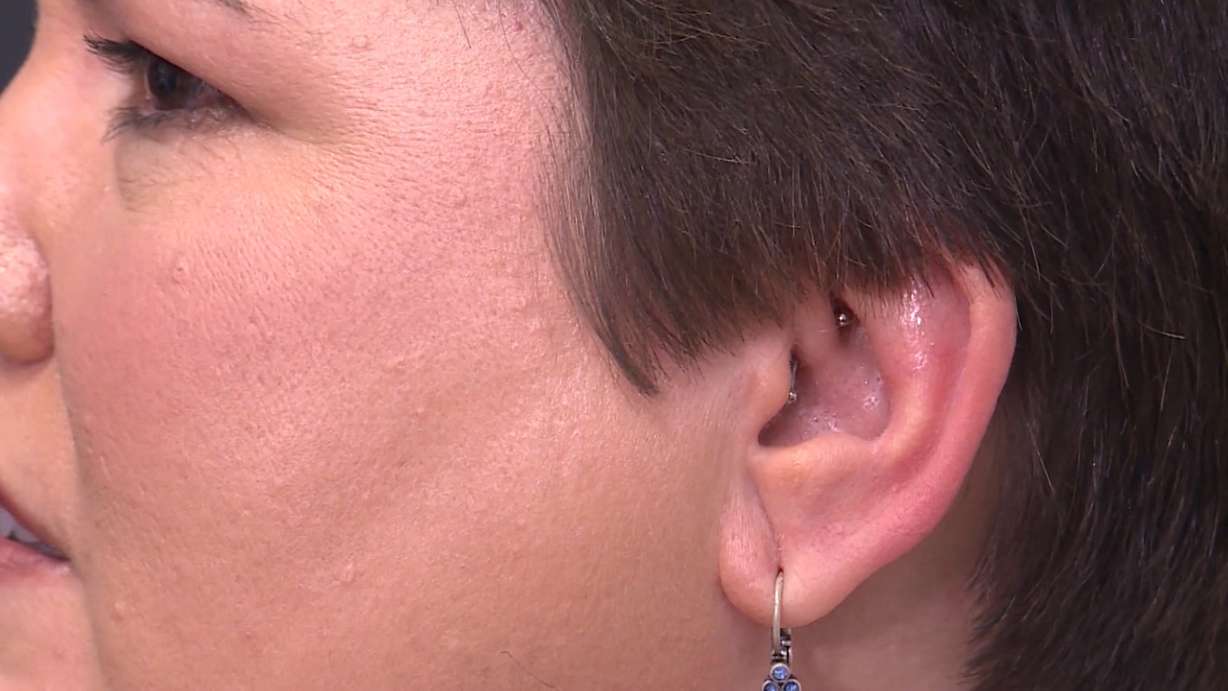 If you’ve ever suffered from a migraine, or have a loved one who has, you know how debilitating the intense headaches can be. But an increasingly popular treatment option has some patients calling the simple piercing a migraine miracle. (Photo: KSL TV)