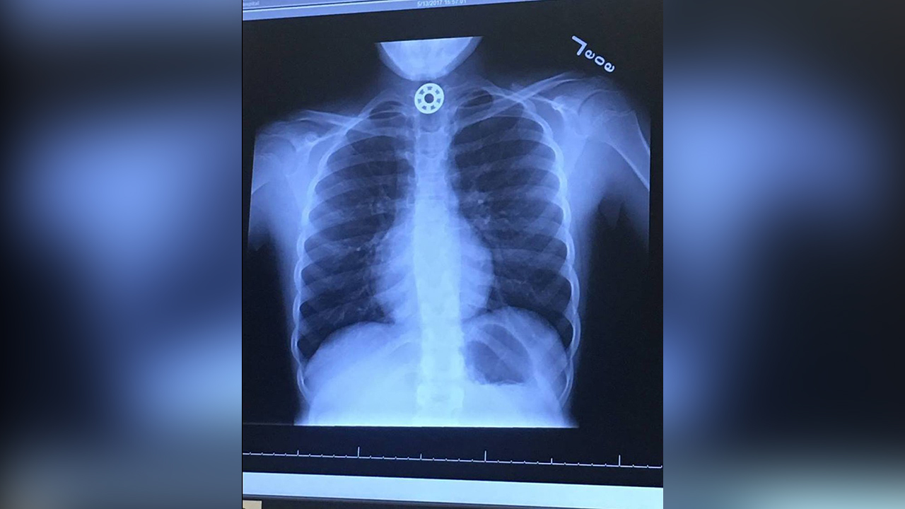 One of the bearings stuck in Britton Janiec's throat. Photo: Courtesy Janiec Family