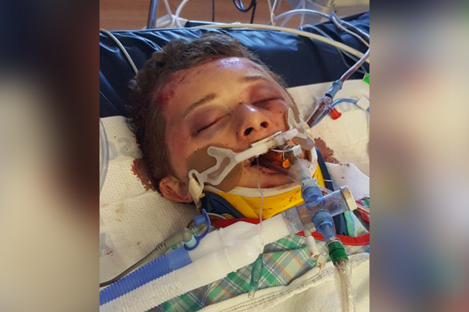 Idaho boy 'stomped into a coma' by 2 juveniles during savage beating