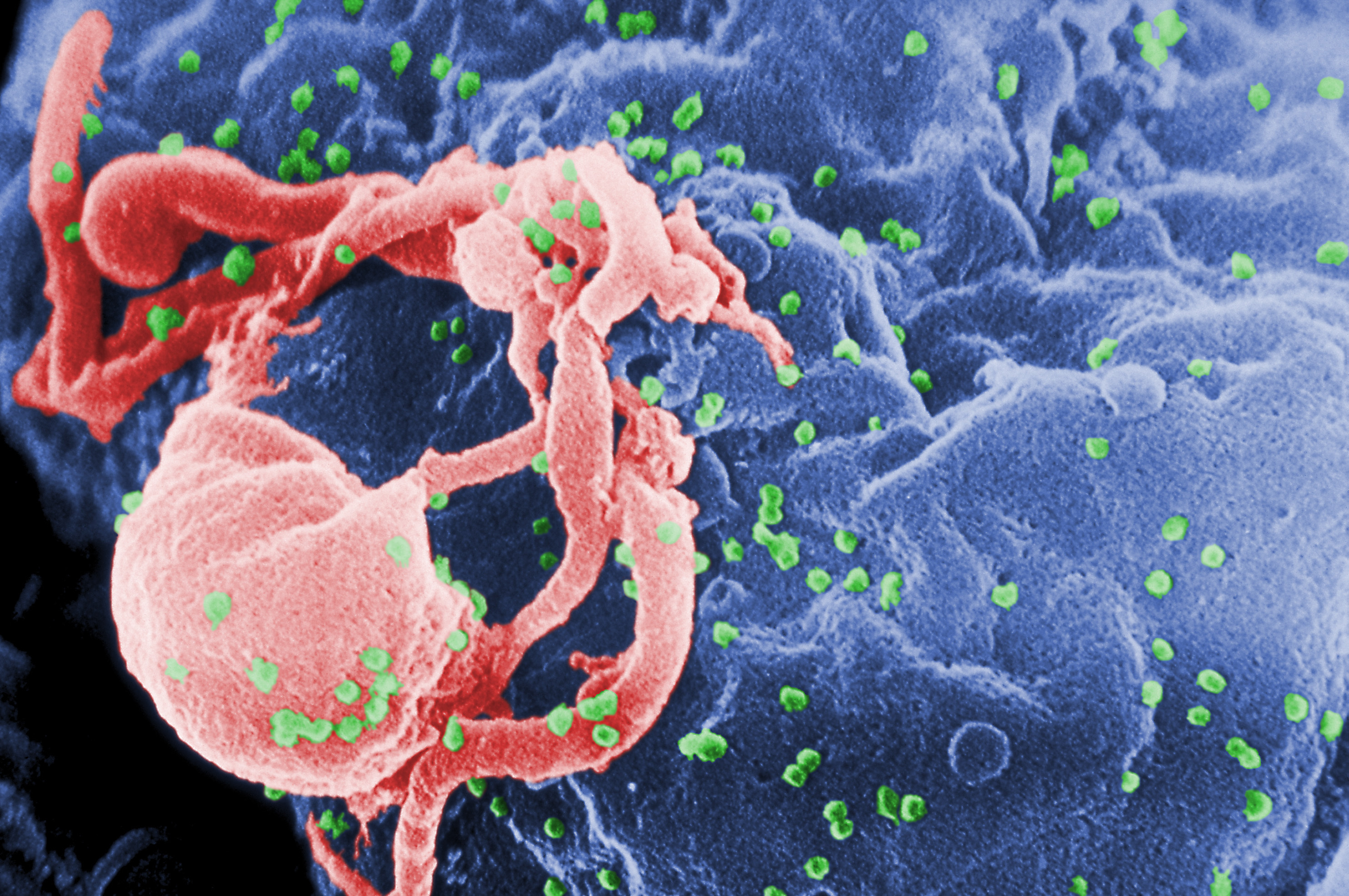 Girl's HIV infection seems under control without AIDS drugs