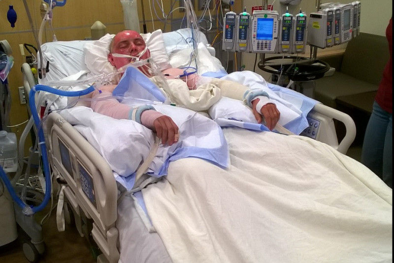 Severely burned fireman credited with saving fellow responder's life