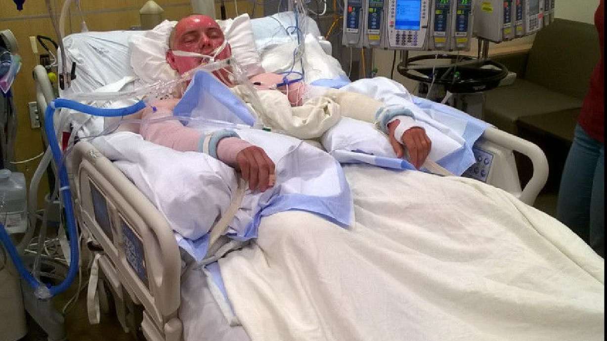 2 injured Idaho firemen airlifted to U. burn center