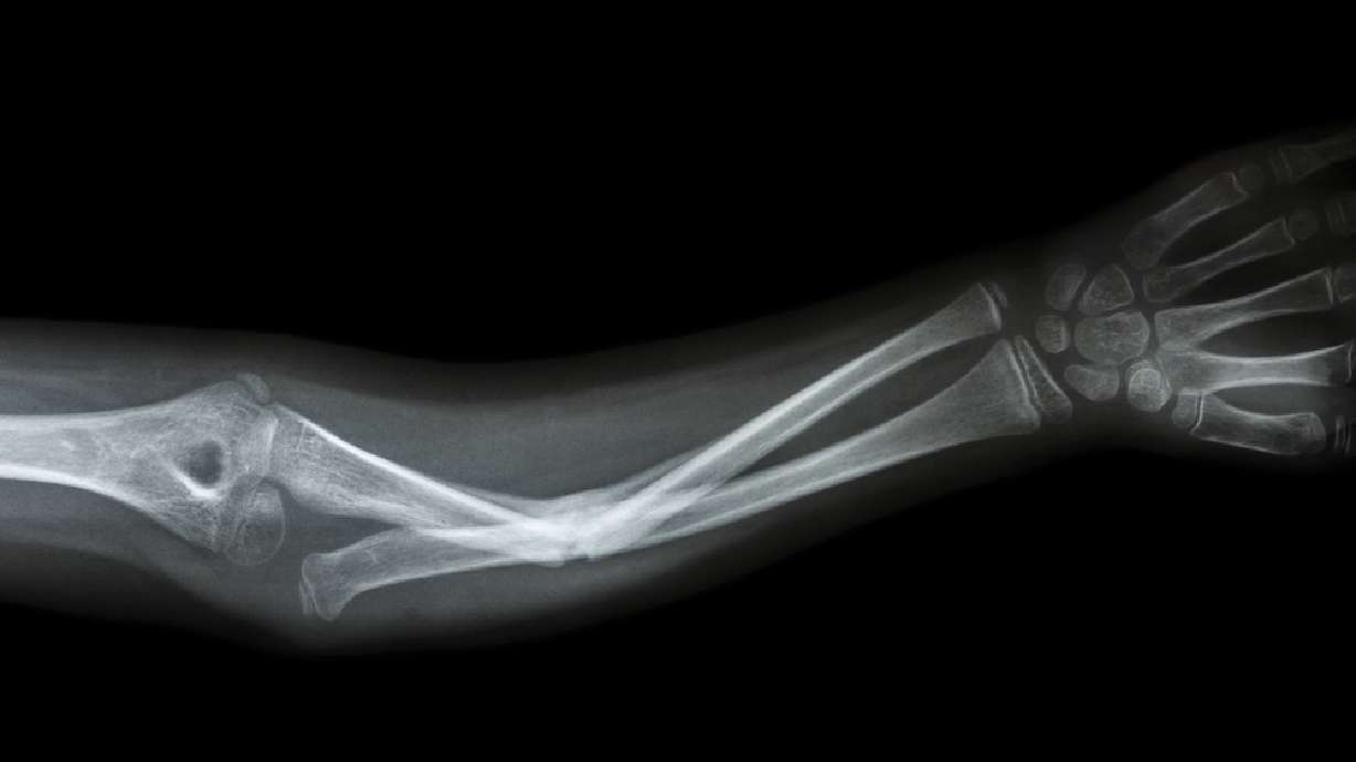 5 common winter accidents treated in Utah emergency rooms