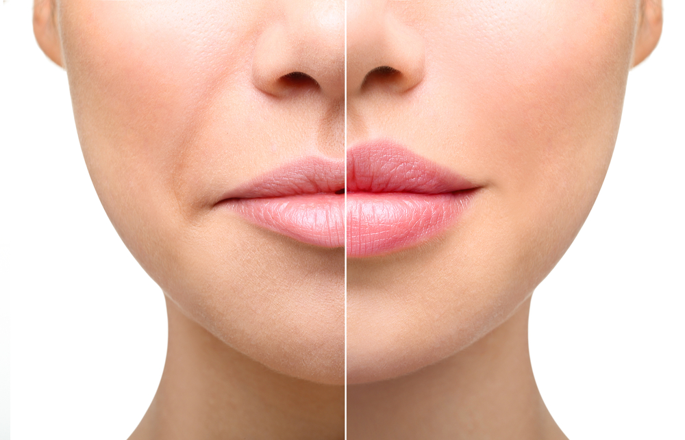 Cosmetic skin fillers rise in popularity, and complications