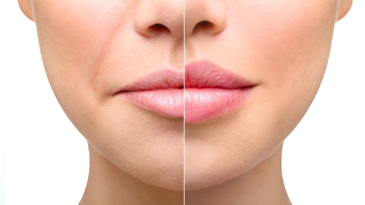 Cosmetic skin fillers rise in popularity, and complications