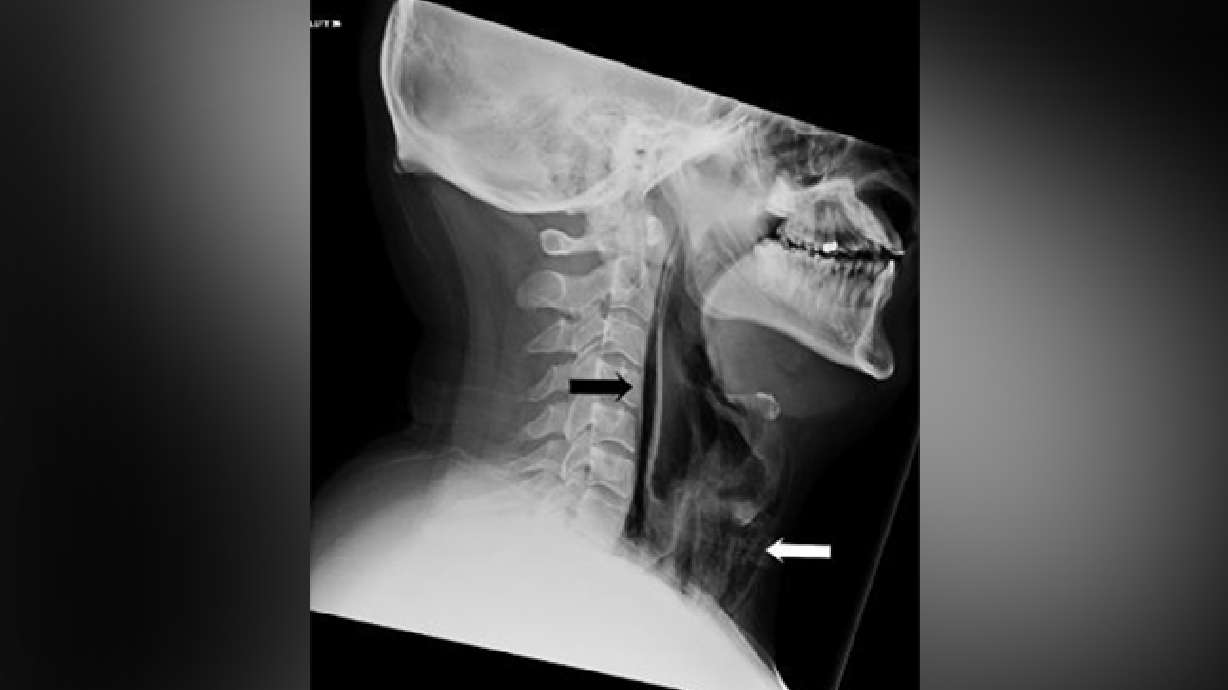 Man blows hole in neck after stifling sneeze, report says