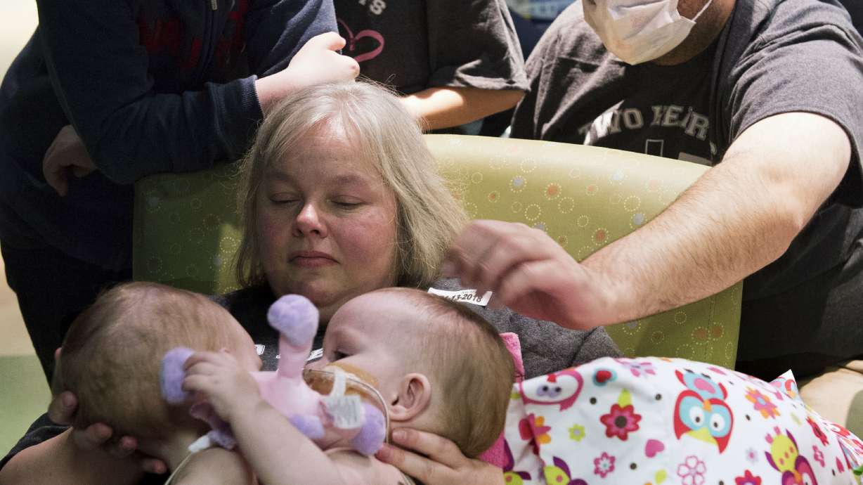 Houston surgeons separate toddlers joined at chest, abdomen