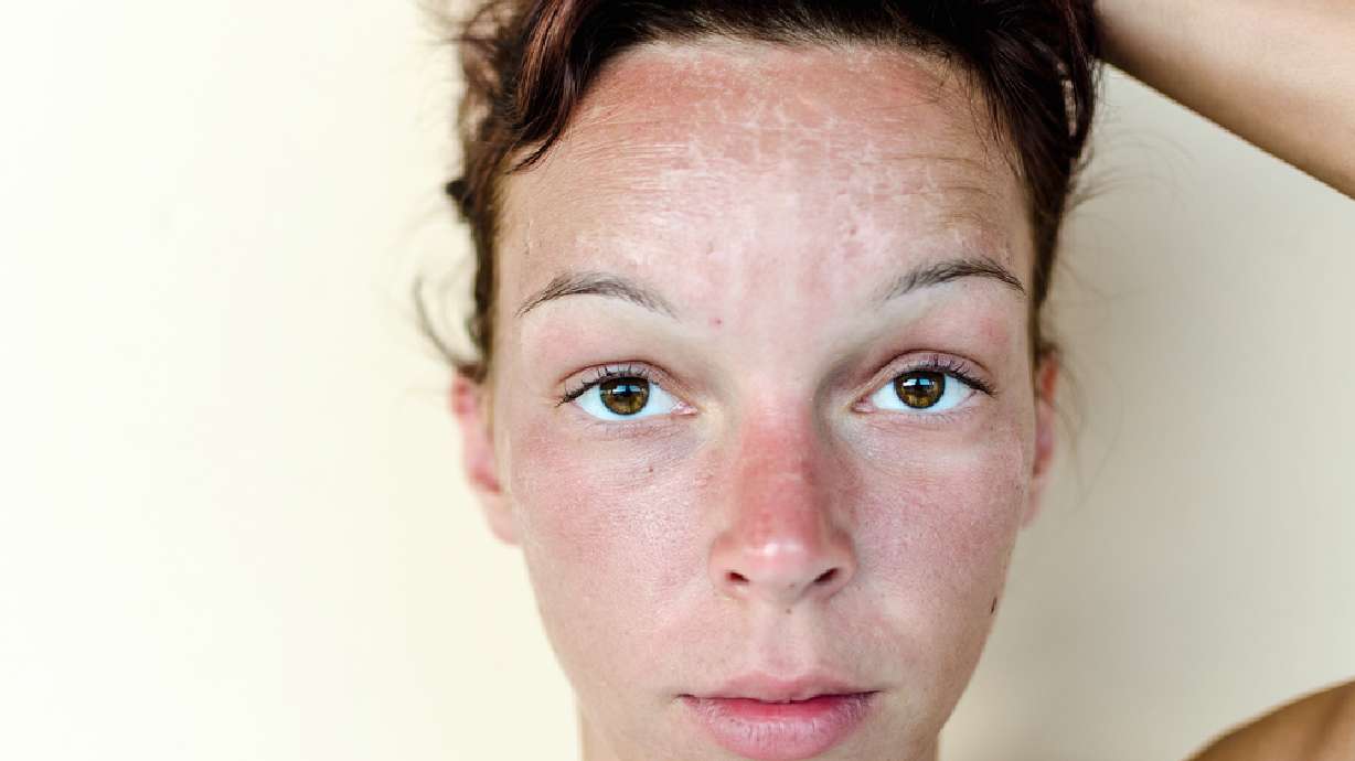 Melanoma rates on the rise in Utah — are you doing enough to prevent it?