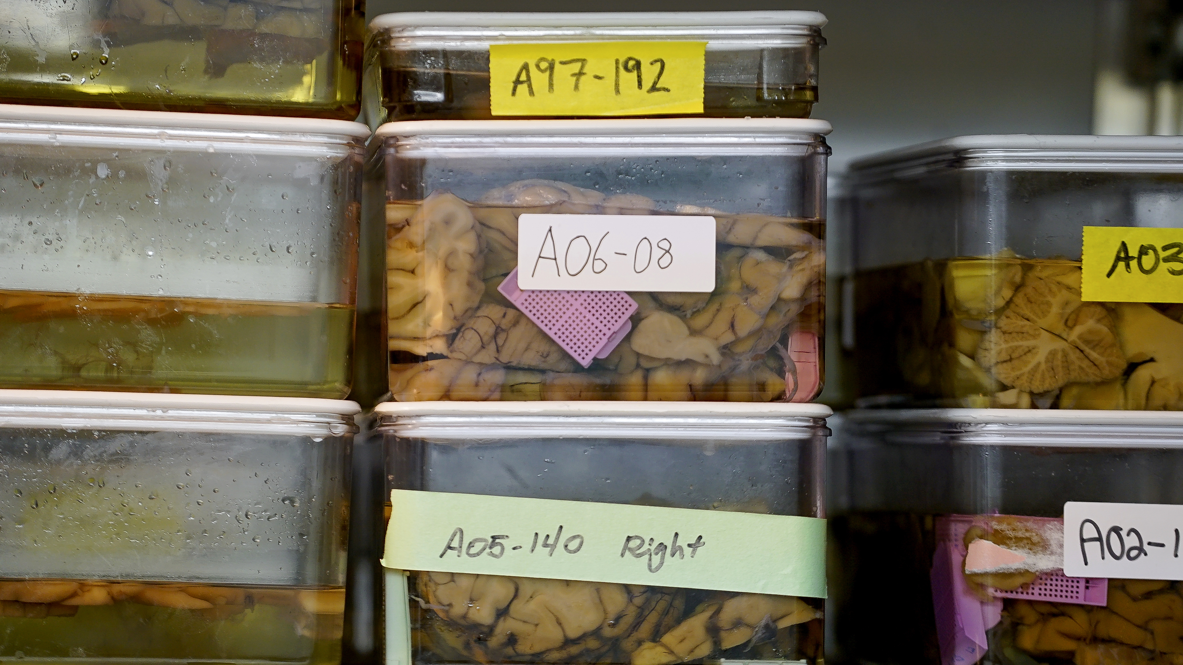 New way of defining Alzheimer's aims to find disease sooner