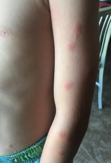 A young boy exhibits signs of swimmer’s itch, Santa Clara, Utah, June 14, 2016. (Photo: Hollie Reina, St. George News)