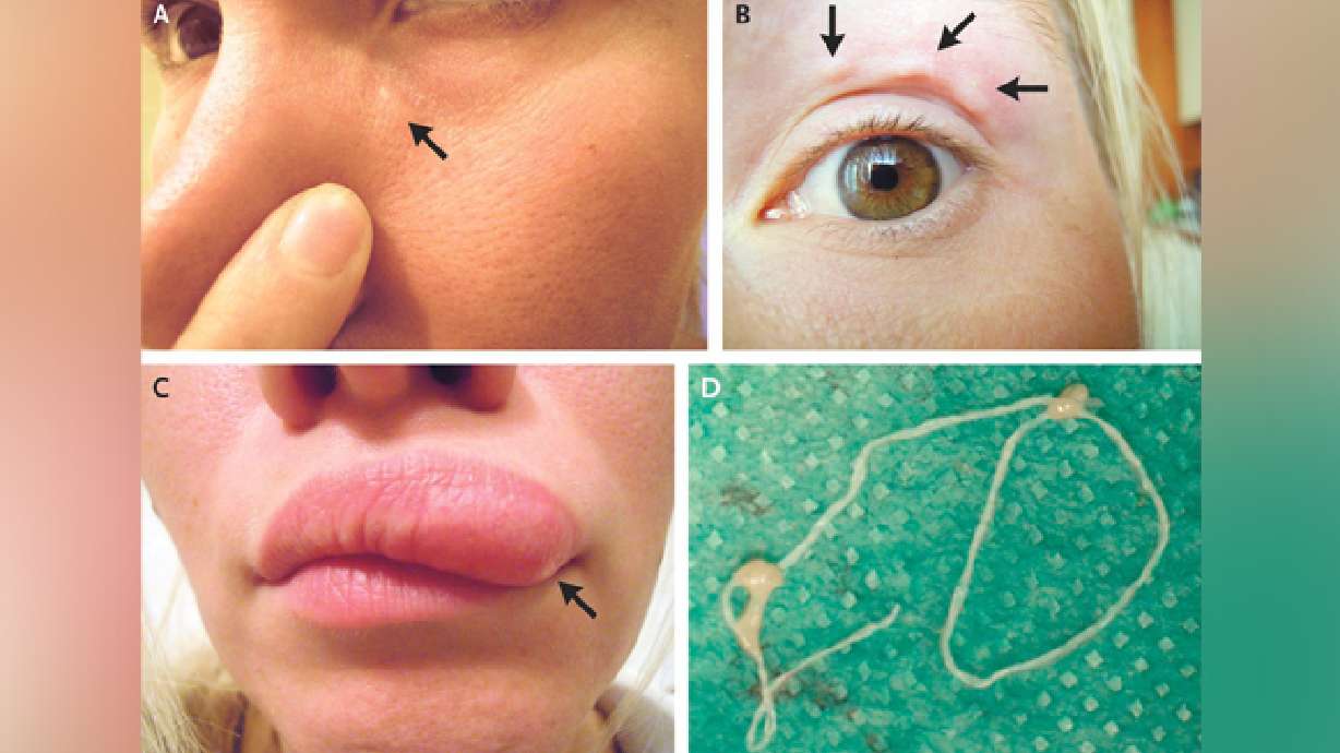 Woman's selfies capture moving lump on face: a parasite