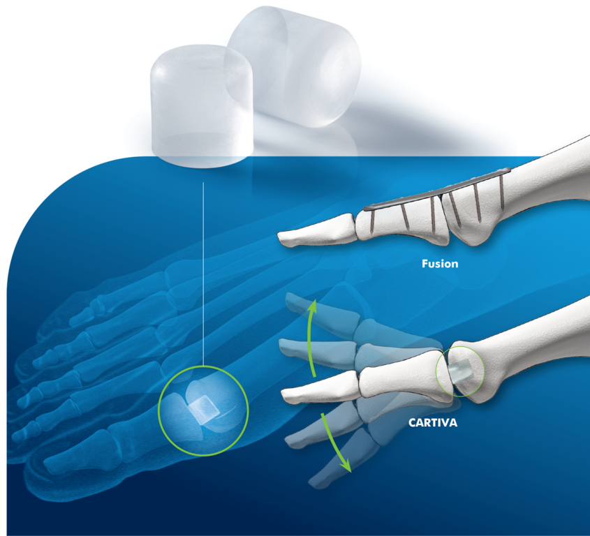 Cartiva is a synthetic cartilage the size of a pencil eraser and made of polyvinyl alcohol FDA-approved for use to replace worn-down cartilage in the big toe joint. (Photo: Cartiva)