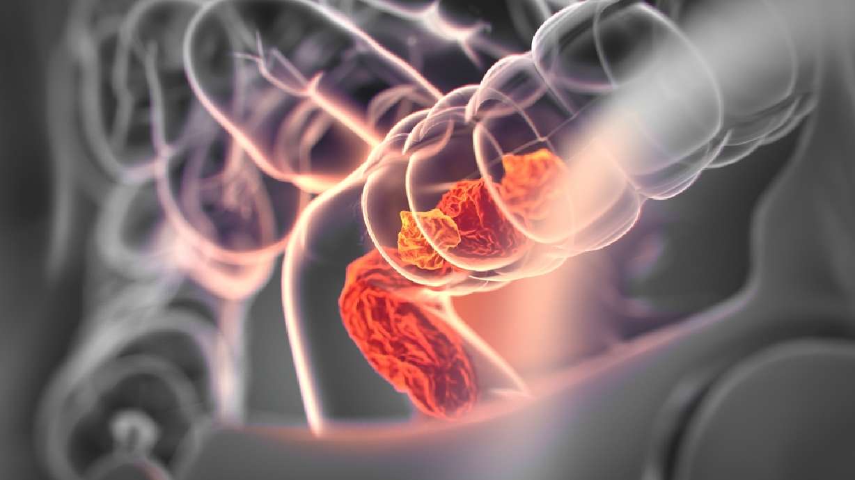 Millennials are getting colon cancer. Why?